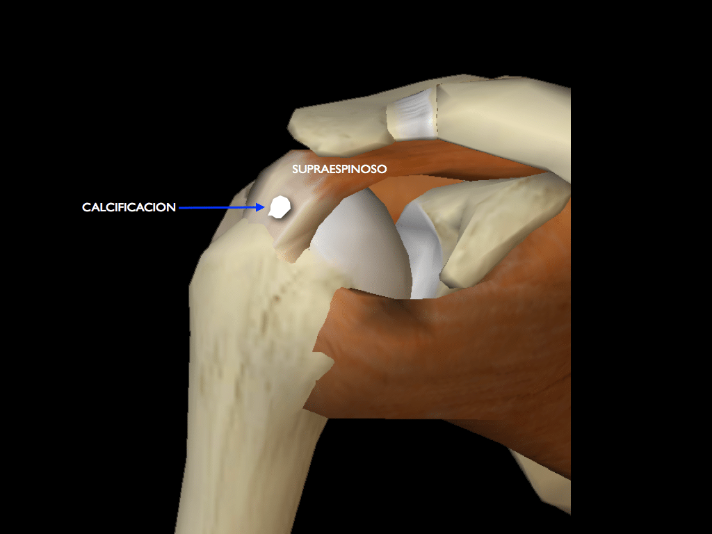 calcifications
