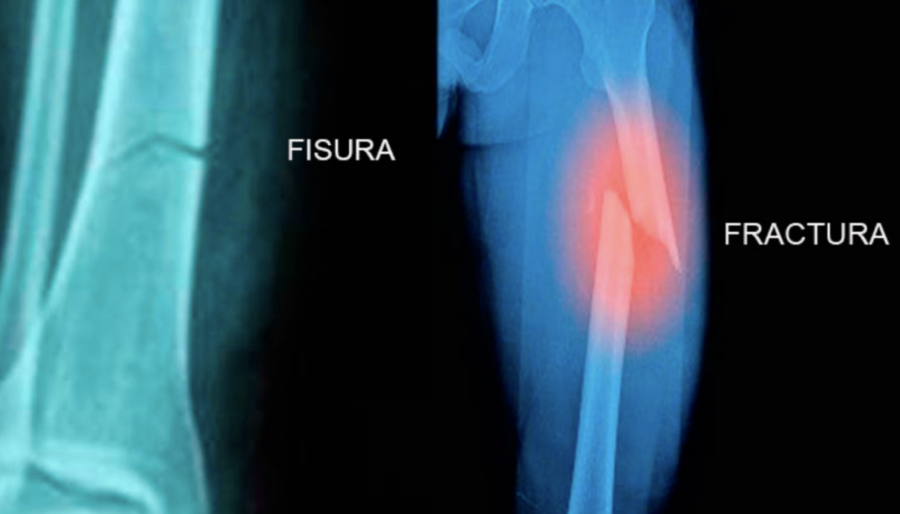 Diferencia entre fisura ósea y fractura de hueso
