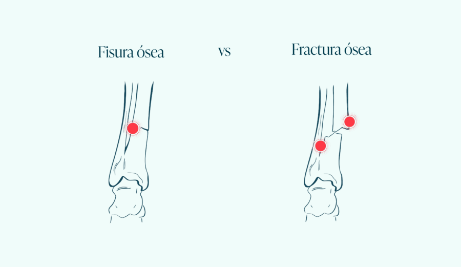 What is a fracture and a fissure? How can we differentiate between them? Are they treated in the same way? Tips.