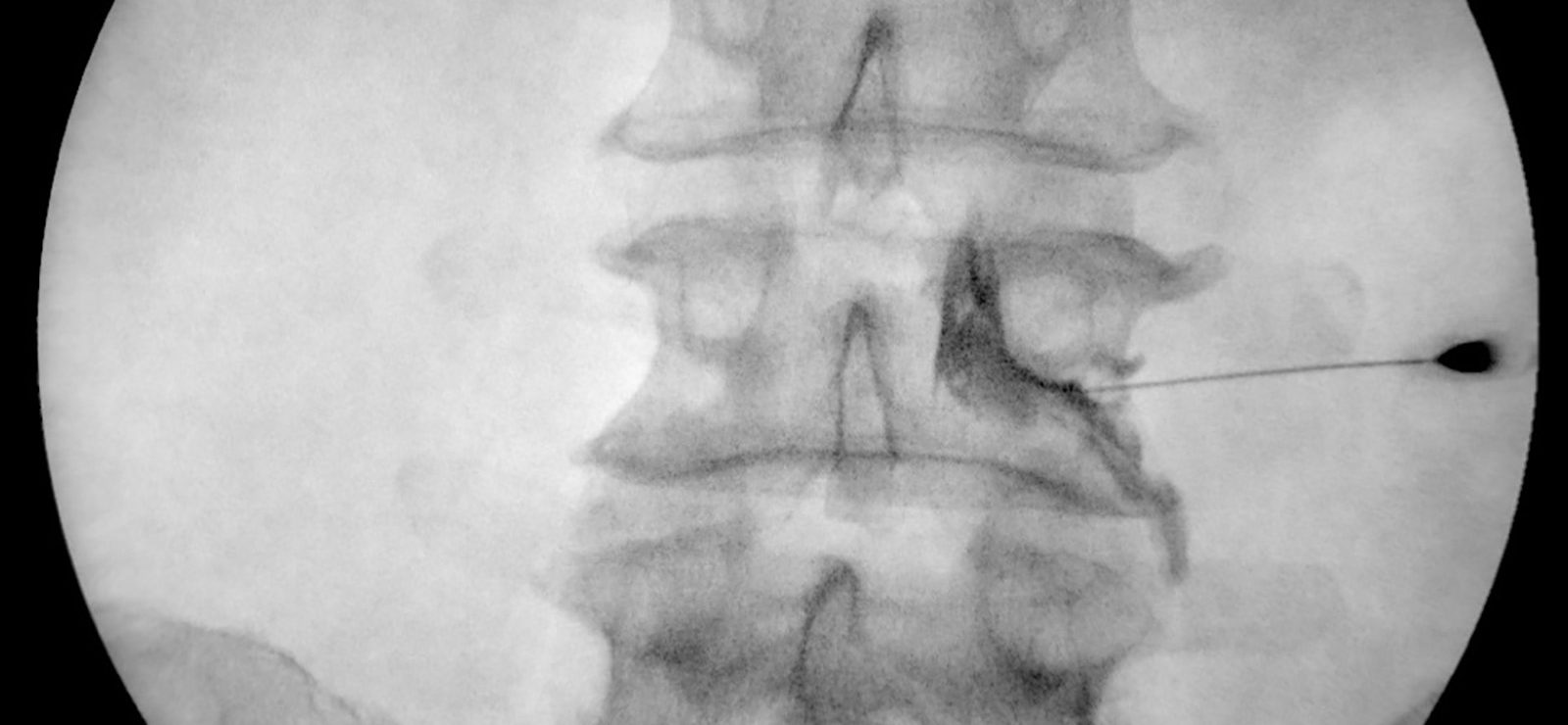 We tell you how we improve pain with infiltrations. | Mivi